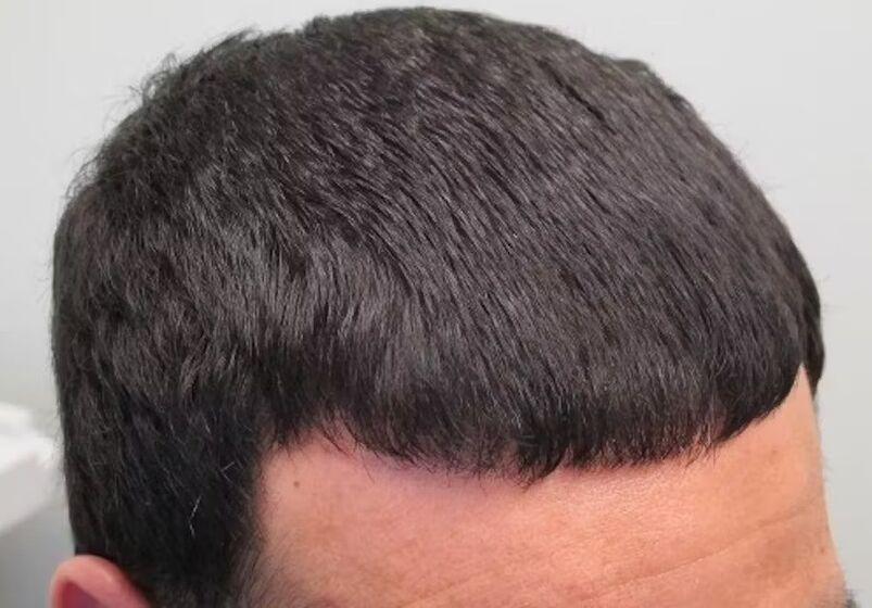 J'ai guéri la perte de cheveux verdoxidil